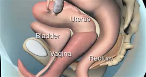 Info Oecd [view 37 ] 4th Degree Uterine Prolapse Pictures