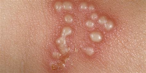 herpes simplex symptoms causes pictures treatment prognosis diseases pictures