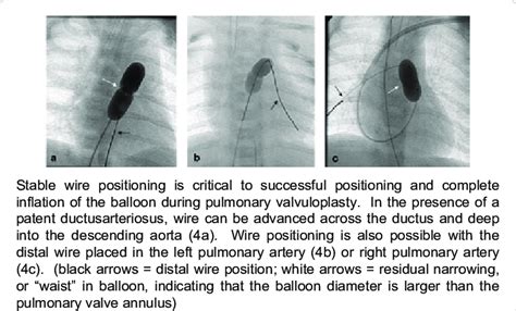 Wire Positioning For Balloon Pulmonary Valvuloplasty