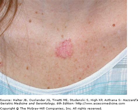 melanoma skin cancer  chest
