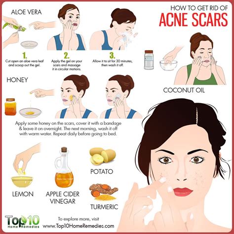 rid  acne scars top  home remedies