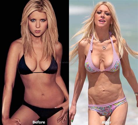 Tara Reid Plastic Surgery Gone Wrong Before And After