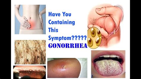 gonorrhea symptoms  std youtube