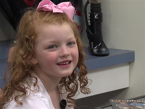 5 Year Old Girl Without Fingers Gets 3d Printed Prosthetic Hand