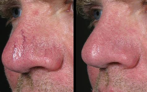 Laser For Facial Redness 6 Md Esthetics