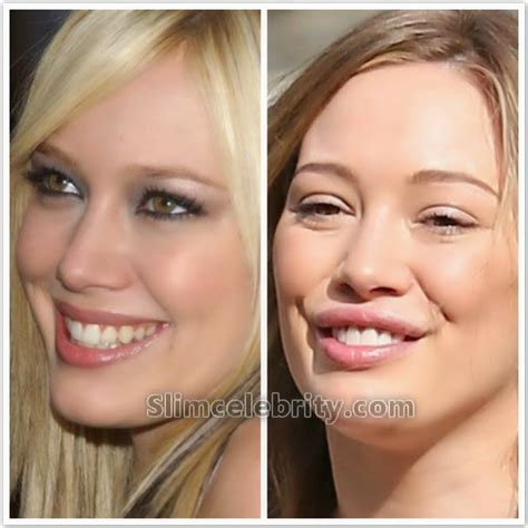did hilary duff get plastic surgery lips breast implants nose jobs