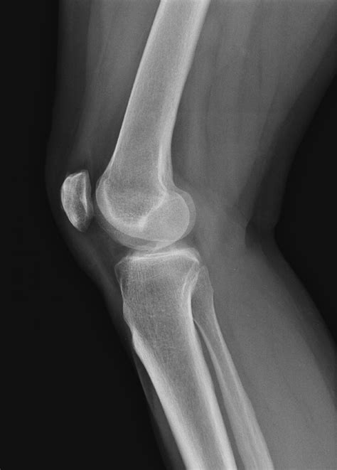 normal knee 2 buyxraysonline