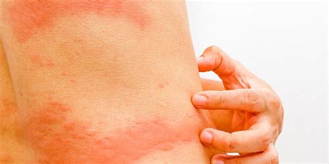 What S That Rash On Your Body 5 Common Types Explained Prevention