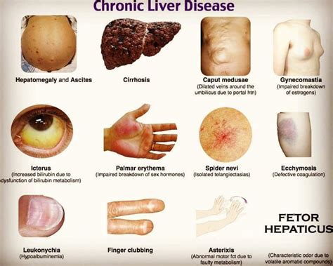 liver cirrhosis early stage ascites symptoms symptoms  disease