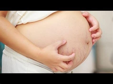 mengatasi gatal berlebih  perut   hamil youtube