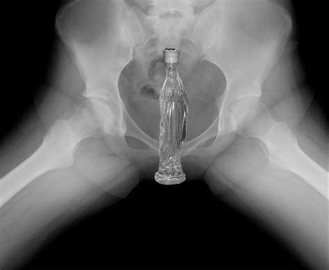 xray of gay anal penetration
