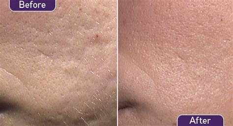 acne marks dermandtek dermatologia andorra