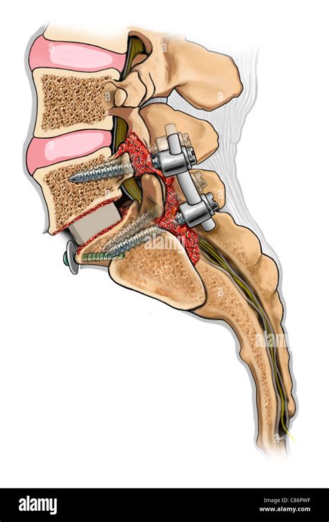 lumbar spinal fusion surgery