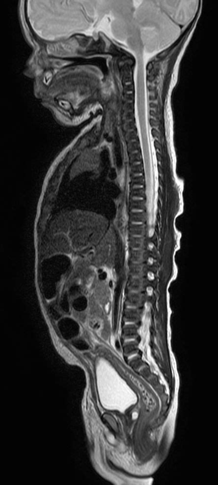 pediatric total spine with spina bifida philips mr body map