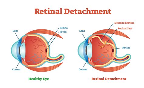 surgery  retinal detachment nader moinfar md mph facs fasrs
