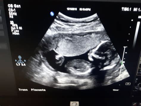 How Accurate Is Gender Guess At 17 Weeks March 2020 Birth Club