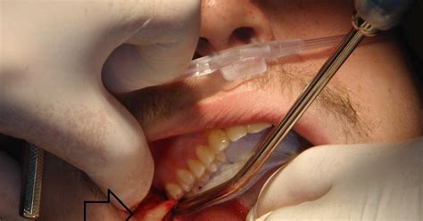 Post Wisdom Tooth Surgery Treatment Dental Dentist