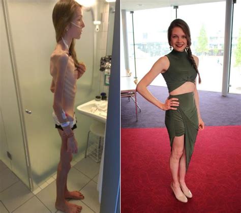Anorexic Girl Inspires People To Get Healthy After Being
