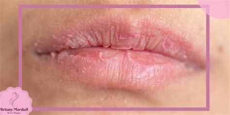 10 Ways How To Get Rid Of Dead Skin On Lips Easy 2023 Guide