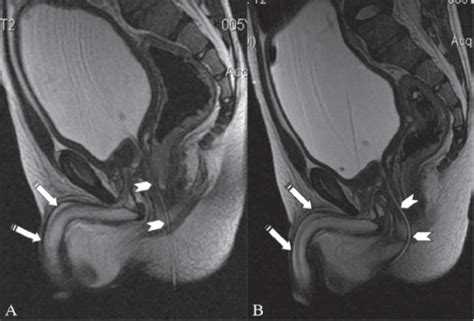 sagittal t2w images show a small caliber cannula in the open i