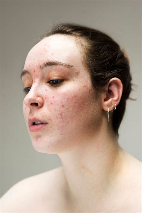 Portraits Of People S Skin Conditions Celebrate The Beauty Of