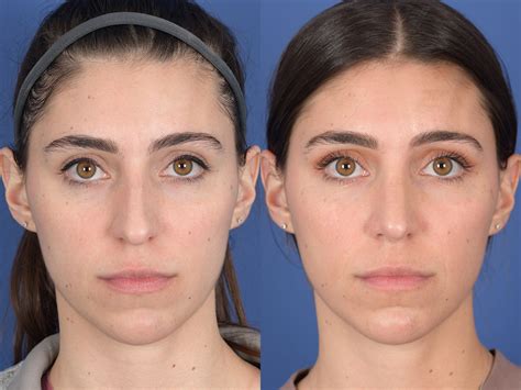 Rhinoplasty Before And After 89 Weber Facial Plastic Surgery