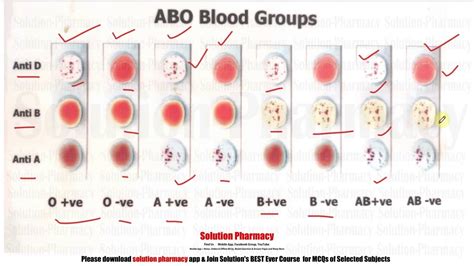 blood group test determination  blood group  blood group