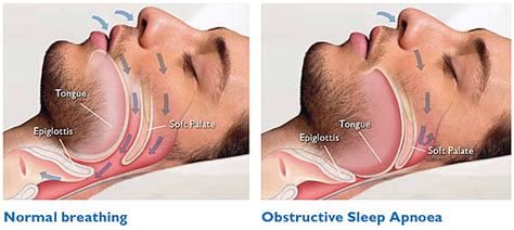 Know About Sleep Apnea And Its Treatment Dentalimplantindia