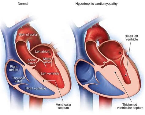 left   ventricular outflow tract obstruction  symptoms
