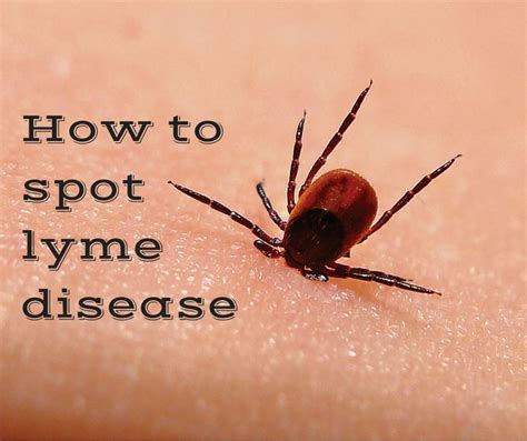 ticks  lyme disease   symptoms  lyme disease lyme