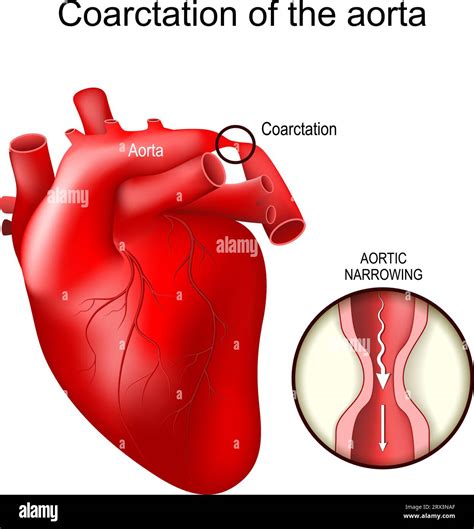 Les Coarctations Aortiques Malformation Cardiaque Congénitale Gros