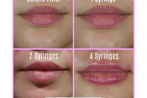 syringes filler lip results charmed medispa