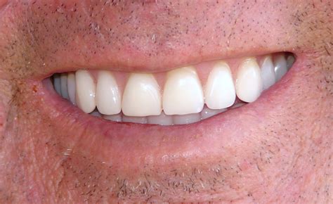 dentures cost