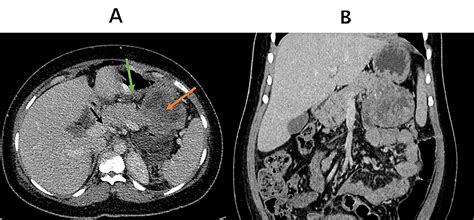 Cureus A Rare Case Of Solid Pseudopapillary Neoplasm Of The Pancreas