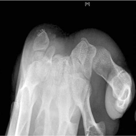 bone widening   pisiform bone  carpal tunnel  ray view