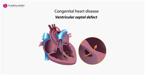 congenital heart defect      save  unborn child