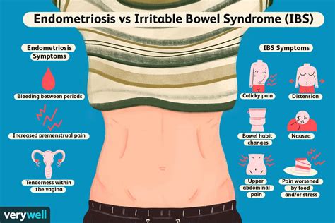 The Differences Between Endometriosis And Ibs