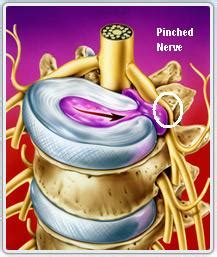 pinched nerve symptoms  treatment  home remedies