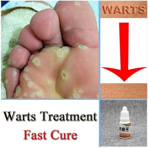 chinese medicine treatment foot corn removal plantar warts