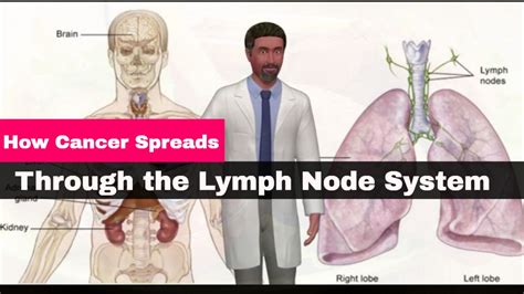 cancer spreads   lymph node system male health clinic