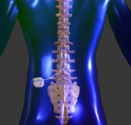 spinal cord stimulator samuel grodofsky md pain management