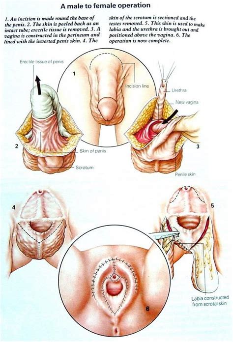 post op transsexual vaginas 47avenue sex reassignment