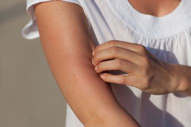 itchy skin treatments   prevention healthdirect