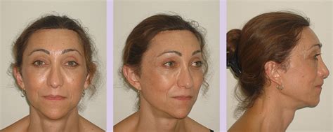 Facial Feminization Surgery Before And After Result