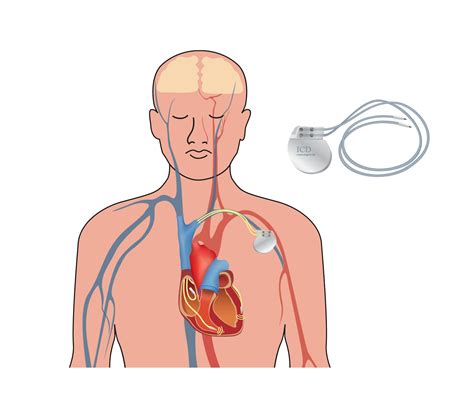 pacemaker en icd deventer ziekenhuis