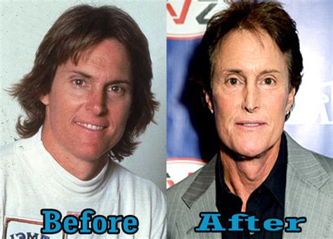 bruce jenner plastic surgery before after body size