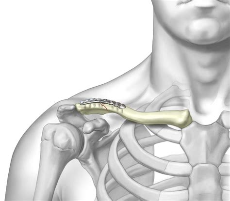 superior lateral clavicle plate upper extremity fixation trimed