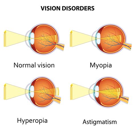 myopia hyperopia  astigmatism explained