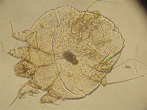 scabies bites pictures symptoms and treatments