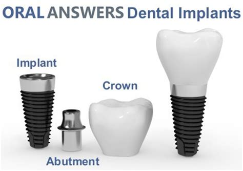 parts   dental implant  implant abutment  crown oral answers